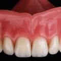 What are Complete Dentures?