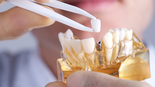 Dental Implant Fabrication